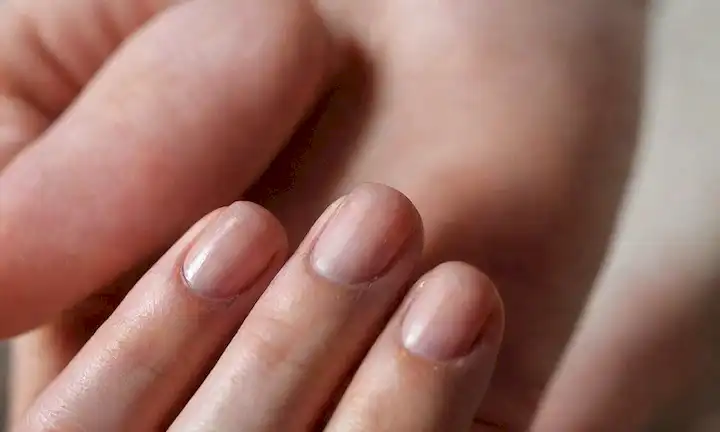 Una toma de cerca de una mano con uñas mordidas, rodeada de enrojecimiento e inflamación, con un fondo borroso para enfatizar el enfoque en el daño de las uñas; un sutil indicio de una expresión facial preocupada o ansioso en el fondo; un brillo débil alrededor de las uñas para significar infección o incomodidad