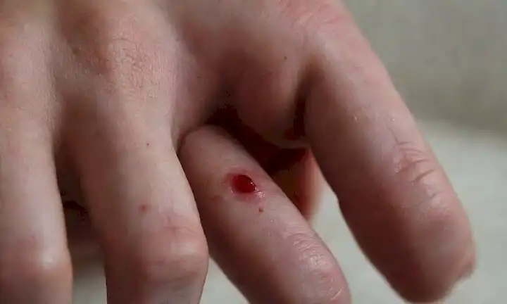 Un acercamiento de una mano con dedos rotos y sangrientos, rodeado de gotitas rojas, un dedo hinchado con una herida abierta, marcas de dientes en una uñas, y un fondo débil insinuando un ambiente oscuro y desordenado, transportando las consecuencias físicas del mordido de uñas
