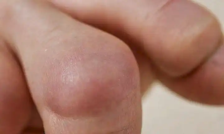 Una mano de personas con un solo dedo enrollado en forma de garra, rodeada de marcas sutiles de uñas y enrojecimiento débil en la piel, contra un suave fondo borroso con un toque de ansiedad y malestar