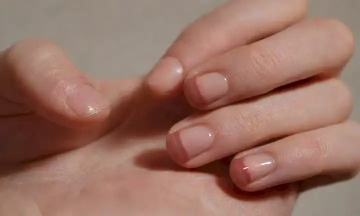 Una mano con clavos mordidos, rodeado de enrojecimiento e inflamación, disparo de acercamiento, luz natural, pose relajada, sombras sutiles, sin distracciones, enfocarse en uñas, destacando las consecuencias físicas del mordido de uñas