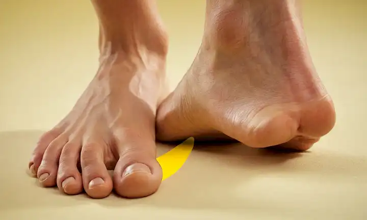 3D rendering of a persons foot with shoes, supinators calf musculars highlighted in yellow, foot arch slightly rolled outwards, soft focus background, sutil gradient effect